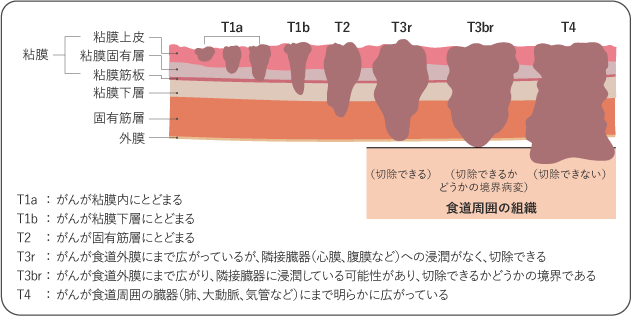 図2 食道がんの深達度の図