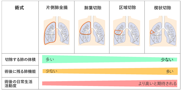 図5 肺がんの手術と術後の状態の図