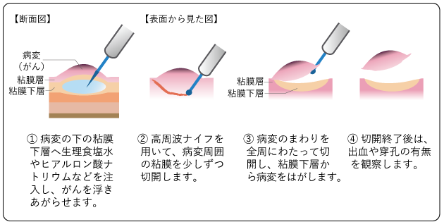 図8 内視鏡的粘膜下層剥離術(ESD)