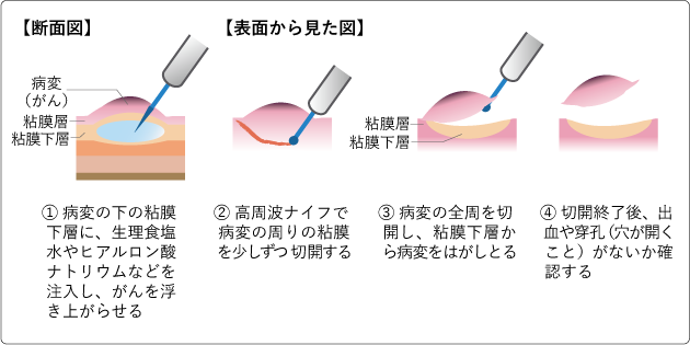 図2　内視鏡的粘膜下層剥離術（ESD）